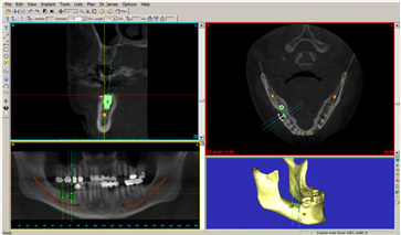 Corson Dentistry Denver planning for implants